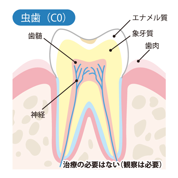 盛岡（盛岡市）の歯医者、医療法人啓仁会 栃内歯科医院のむし歯治療